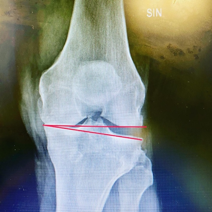 Protesi anca ginocchio chirurgia mininvasiva artrosi Federico Mela alta specialità in chirurgia protesica mininvasiva di anca e ginoncchio monocompartimentale coxartrosi gonartrosi