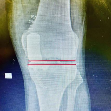 Protesi anca ginocchio chirurgia mininvasiva artrosi Federico Mela alta specialità in chirurgia protesica mininvasiva di anca e ginoncchio monocompartimentale coxartrosi gonartrosi