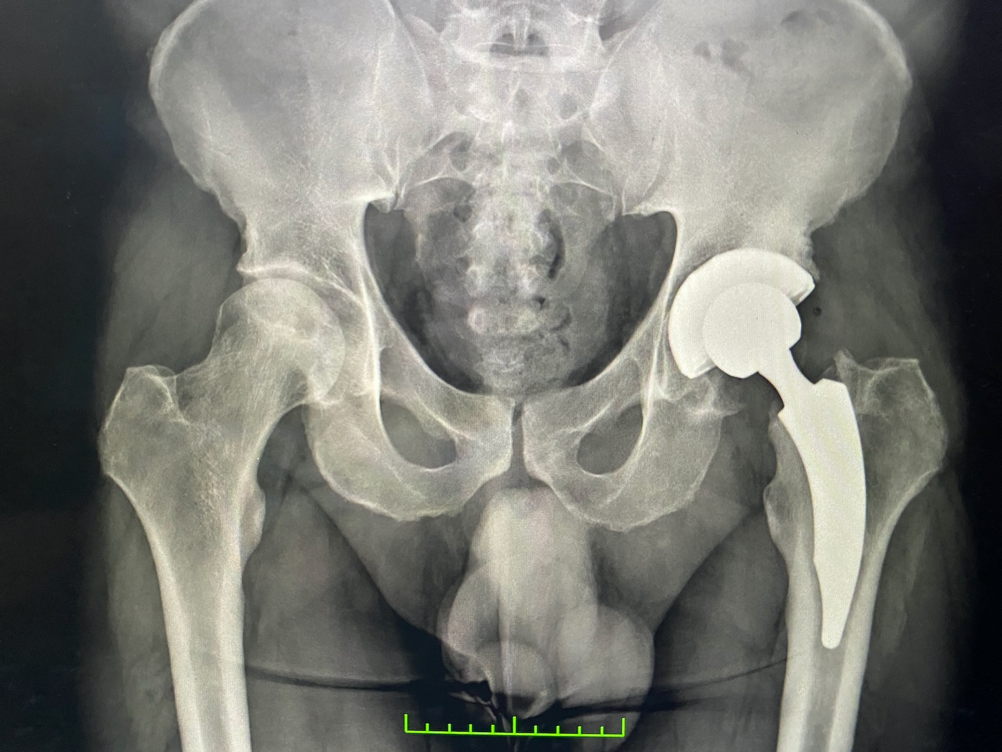 Protesi anca ginocchio chirurgia mininvasiva artrosi Federico Mela ALTA SPECIALITÀ IN CHIRURGIA PROTESICA MININVASIVA DI ANCA E GINOCCHIO _2