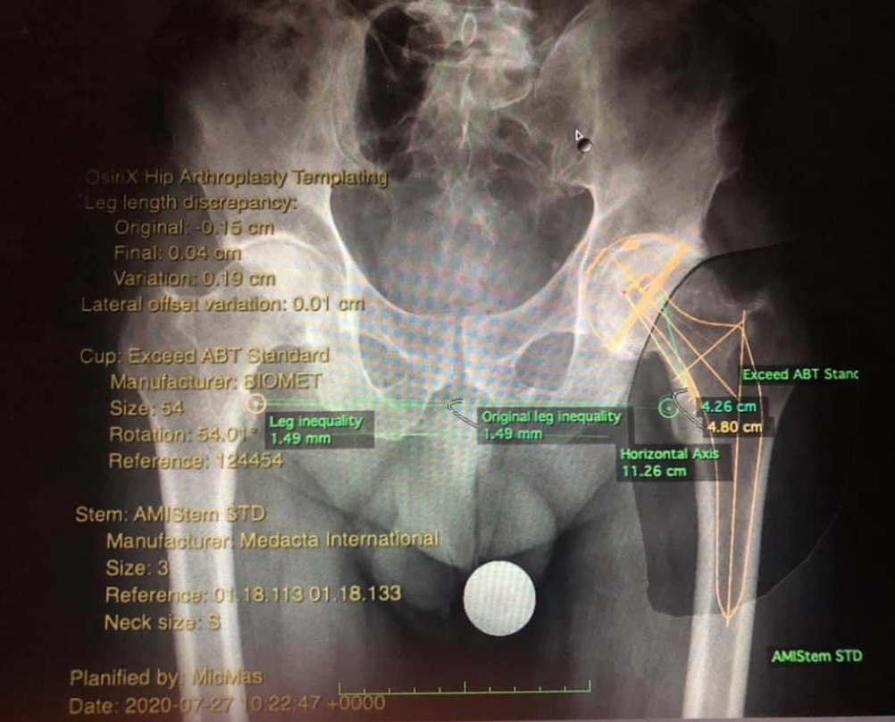Protesi anca ginocchio chirurgia mininvasiva artrosi Federico Mela ALTA SPECIALITÀ IN CHIRURGIA PROTESICA MININVASIVA DI ANCA E GINOCCHIO _2
